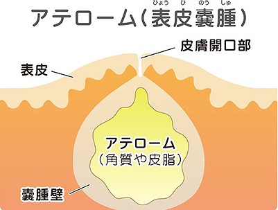 自然には治らない粉瘤という腫瘍