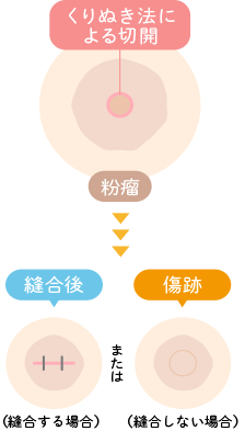 くりぬき法による粉瘤手術