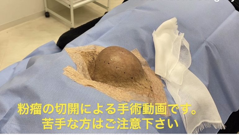 臀部の大きな粉瘤　10cm大